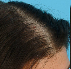 Лечение выпадения волос До и После