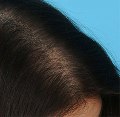 Лечение выпадения волос До и После